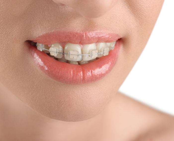 Close up of smile with clear and ceramic braces