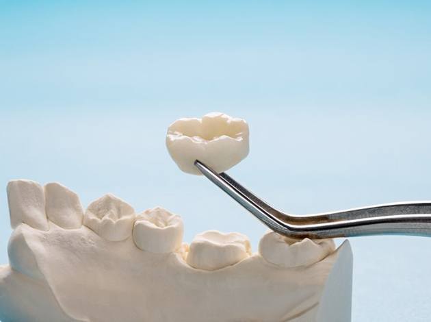 an example of a dental crown