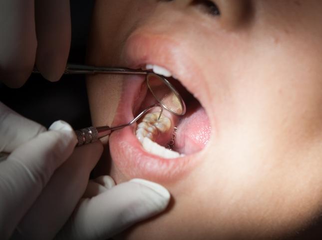 Close up of child receiving a dental exam