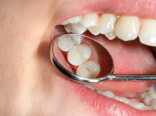 Close up of dental mirror in mouth reflecting a tooth
