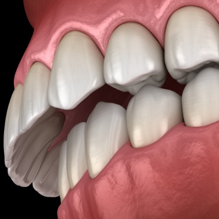 Illustrated mouth with an overbite