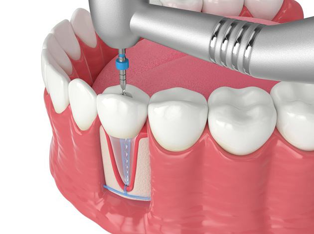 a 3D illustration of the pulp therapy procedure